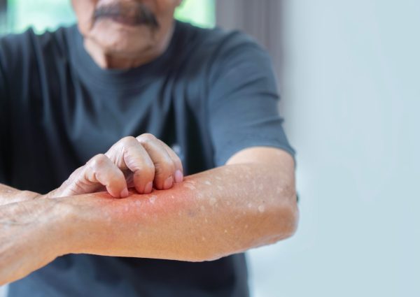 Cropped,Image,Of,Asian,Elder,Man,Scratching,His,Forearm.,Concept